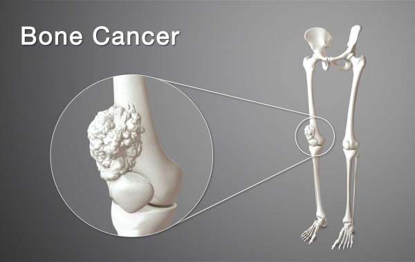 Bone Cancer Disease Treatment Guide | OrthoCenter