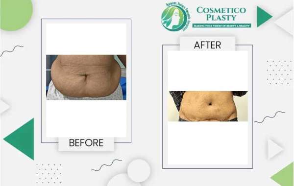 Tummy Tuck Surgery in Lahore: What to Expect and Cost Insights